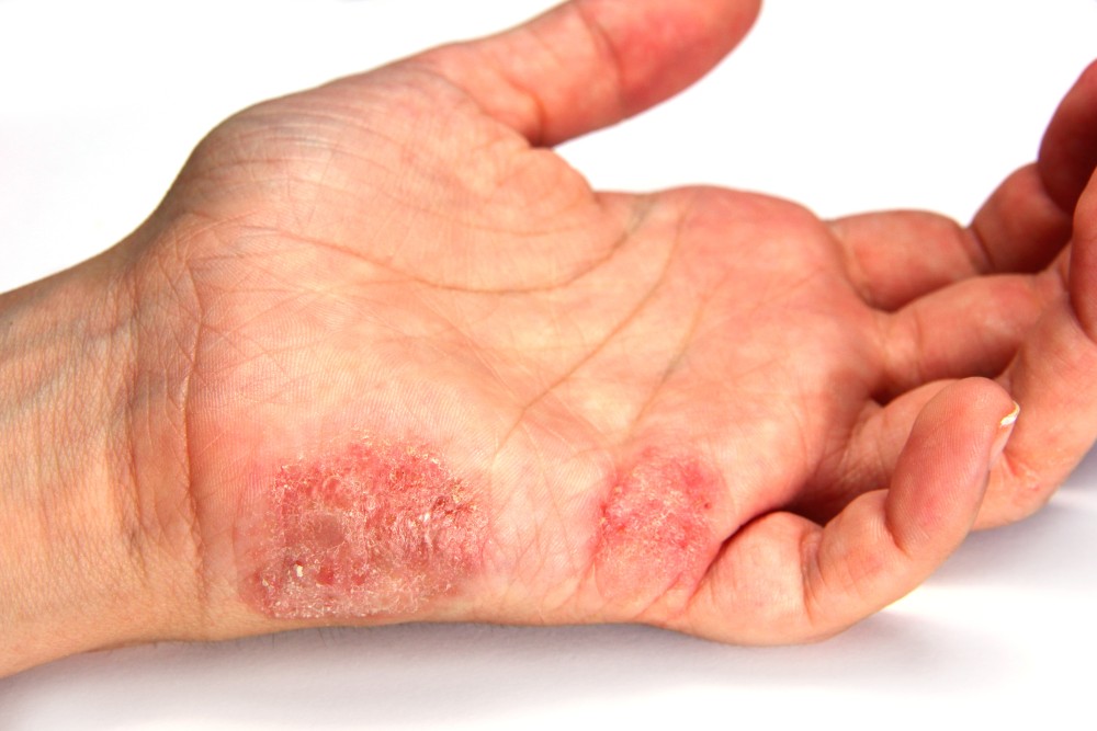 Skin Diseases 
